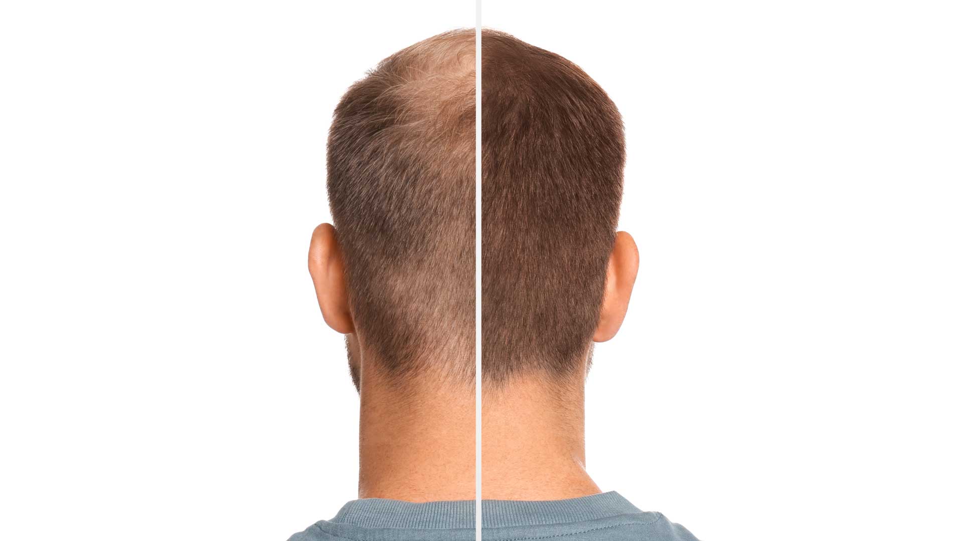 hair loss treatment